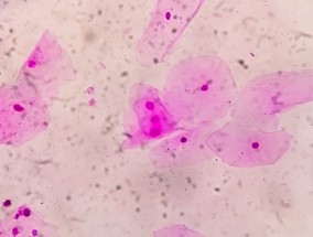 研究：治疗男性伴侣也能帮助治疗常见阴道感染